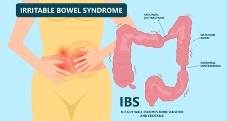 mengenal sindrom usus besar yang sensitif -irritable bowel syndrome-IBS