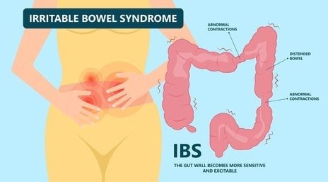 mengenal sindrom usus besar yang sensitif -irritable bowel syndrome-IBS