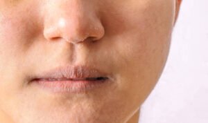penyebab dan cara mengatasi bibir hitam yang mengganggu penampilan